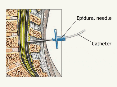 Epidural steroid injection needle length