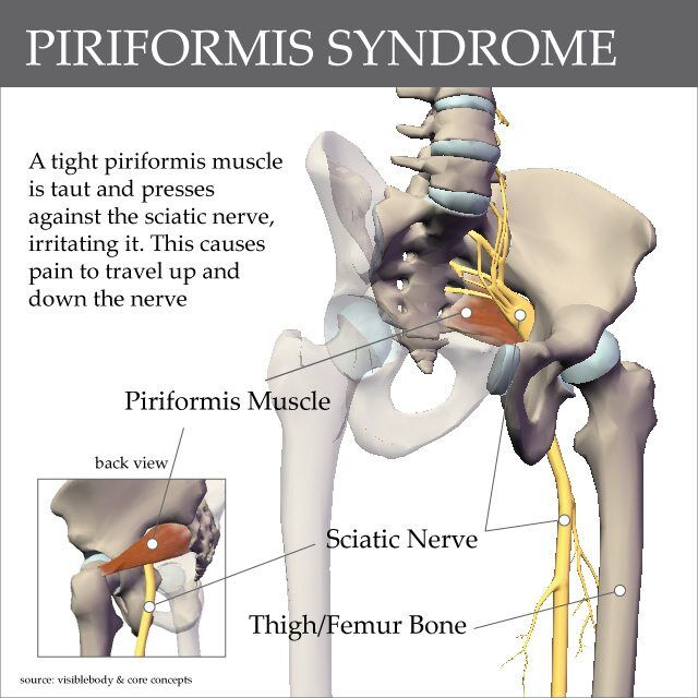 Syndrome piriformis