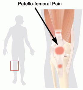 Patella Femoral Pain Syndrome