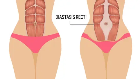 Difference between someone without (left) and with (right) Diastasis Recti Abdominis