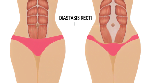 Understanding and Managing Diastasis Recti Abdominis